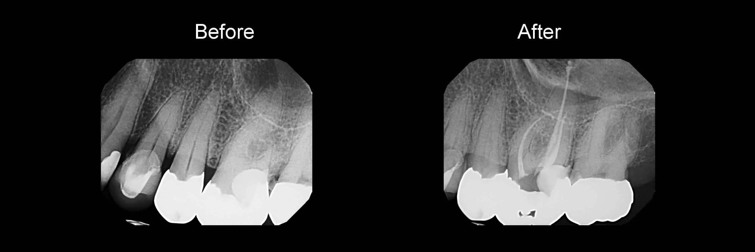 Before and After Safe Root Canals Using Sonendo photo 7