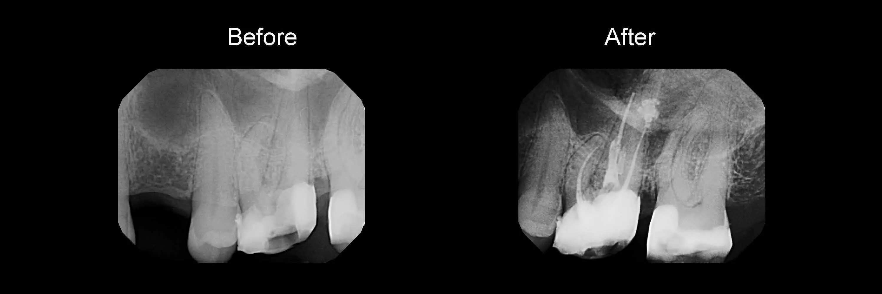 Before and After Safe Root Canals Using Sonendo photo 8