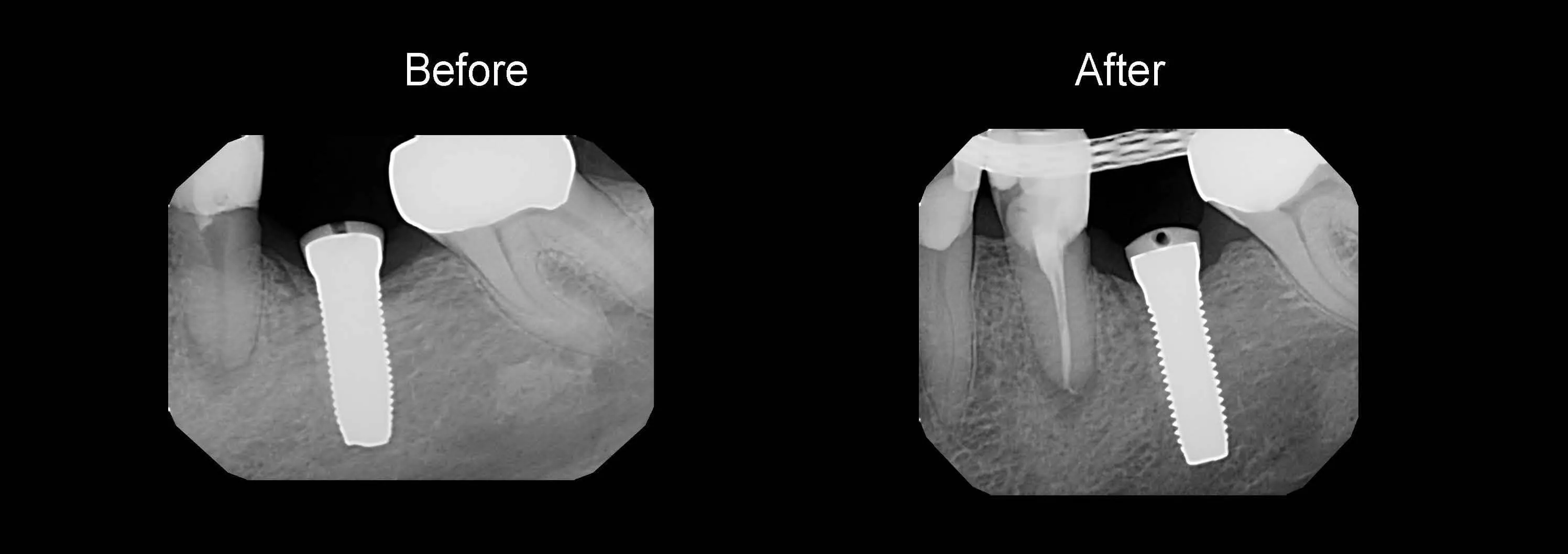 Before and After Safe Root Canals Using Sonendo photo 9