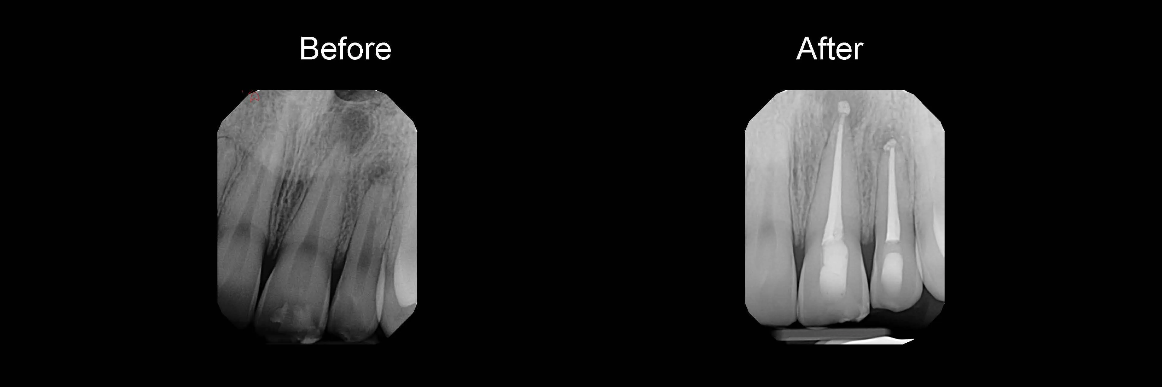 Before and After Safe Root Canals Using Sonendo photo 10