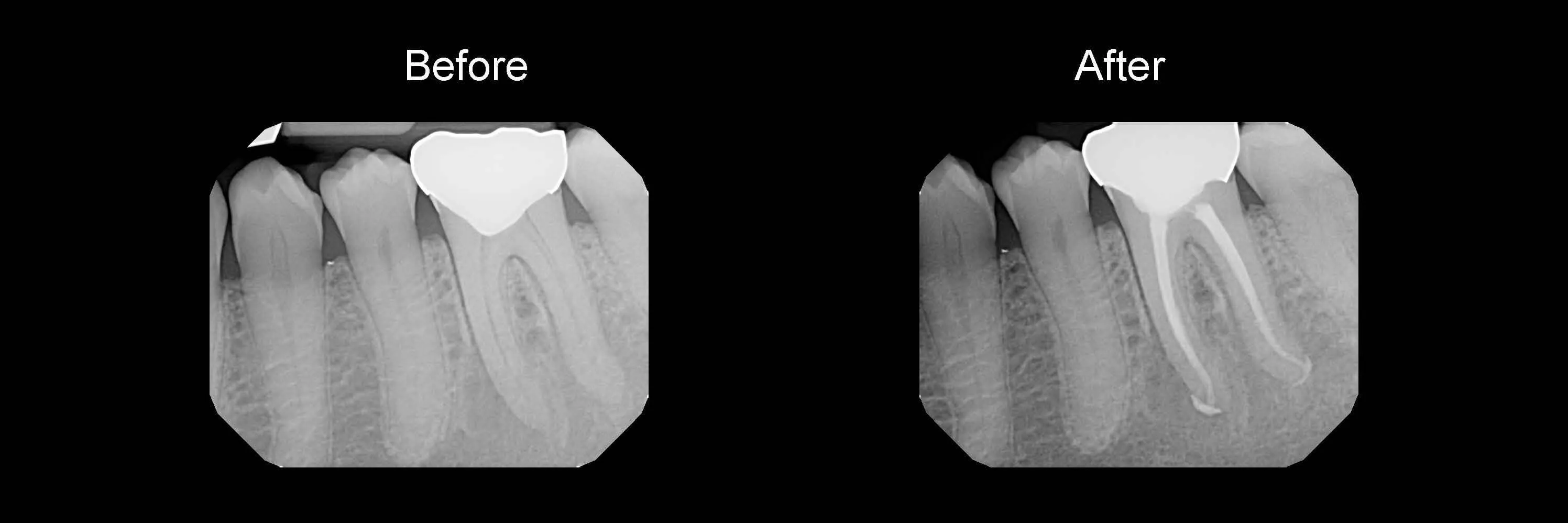 Before and After Safe Root Canals Using Sonendo photo 14