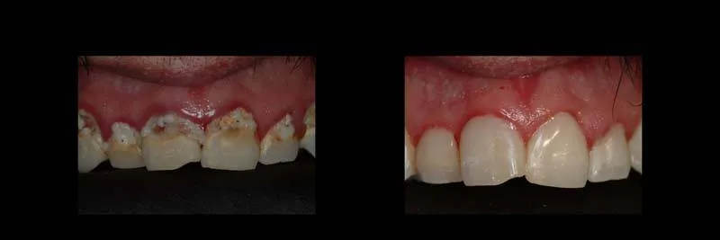 Before and After Composite Restoration & Hygiene Coaching photo 8