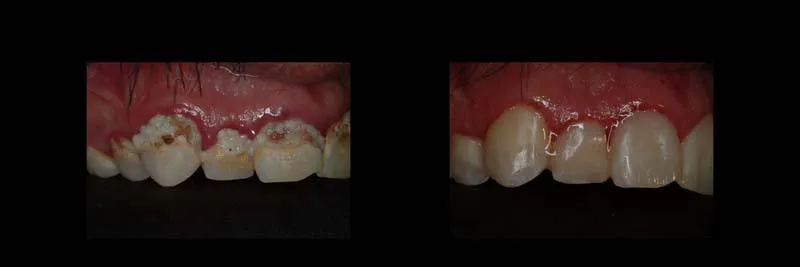 Before and After Composite Restoration & Hygiene Coaching photo 9
