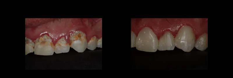 Before and After Composite Restoration & Hygiene Coaching photo 10