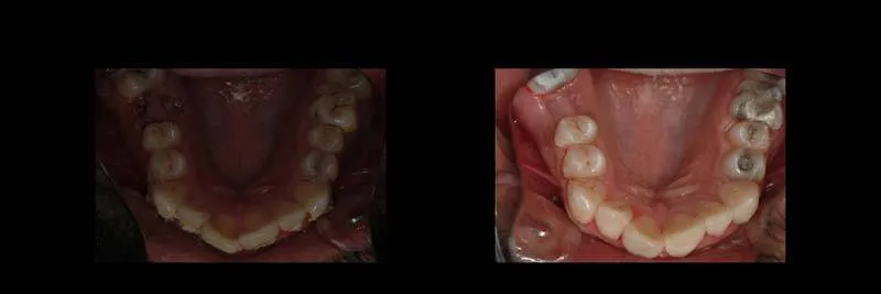 Before and After Composite Restoration & Hygiene Coaching photo 11