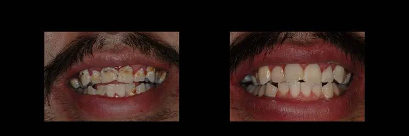 Before and After Composite Restoration & Hygiene Coaching photo 2