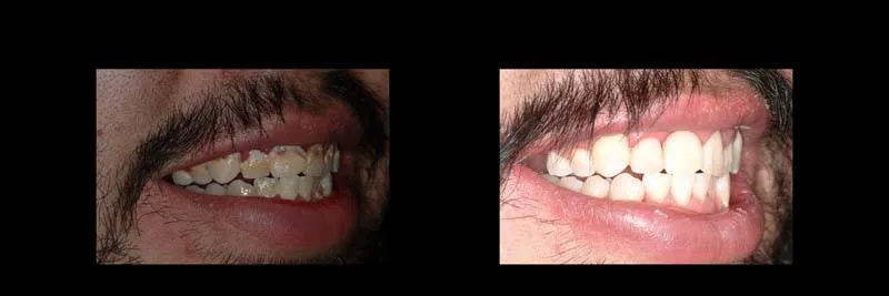 Before and After Composite Restoration & Hygiene Coaching photo 3