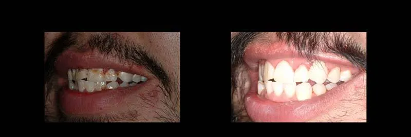 Before and After Composite Restoration & Hygiene Coaching photo 4