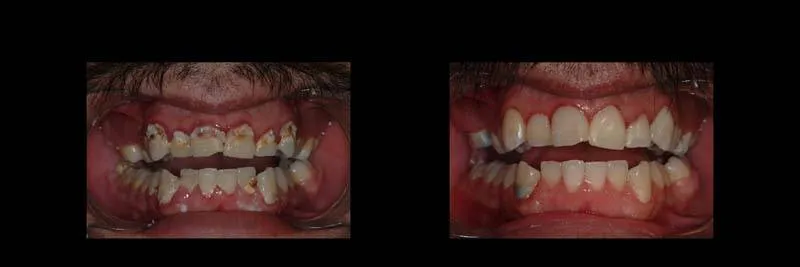 Before and After Composite Restoration & Hygiene Coaching photo 5