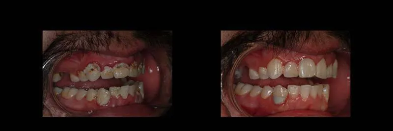 Before and After Composite Restoration & Hygiene Coaching photo 6