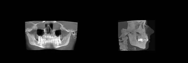 Before and After Invisalign Aligners Full photo 2