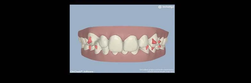 Before and After Invisalign Aligners Full photo 3