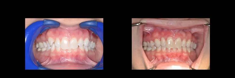 Before and After Invisalign Aligners Full photo 4