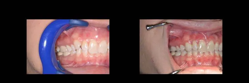 Before and After Invisalign Aligners Full photo 5