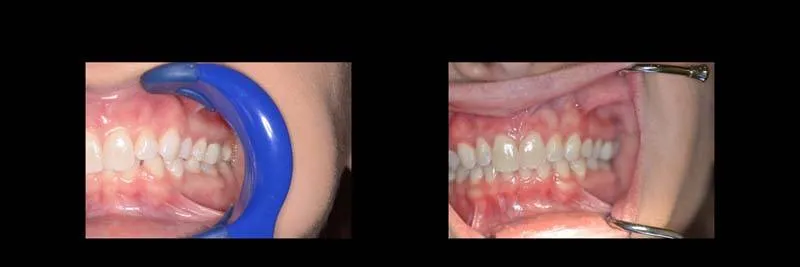 Before and After Invisalign Aligners Full photo 6