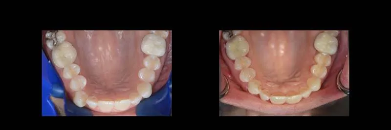 Before and After Invisalign Aligners Full photo 7