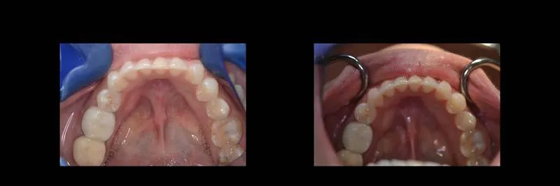 Before and After Invisalign Aligners Full photo 8