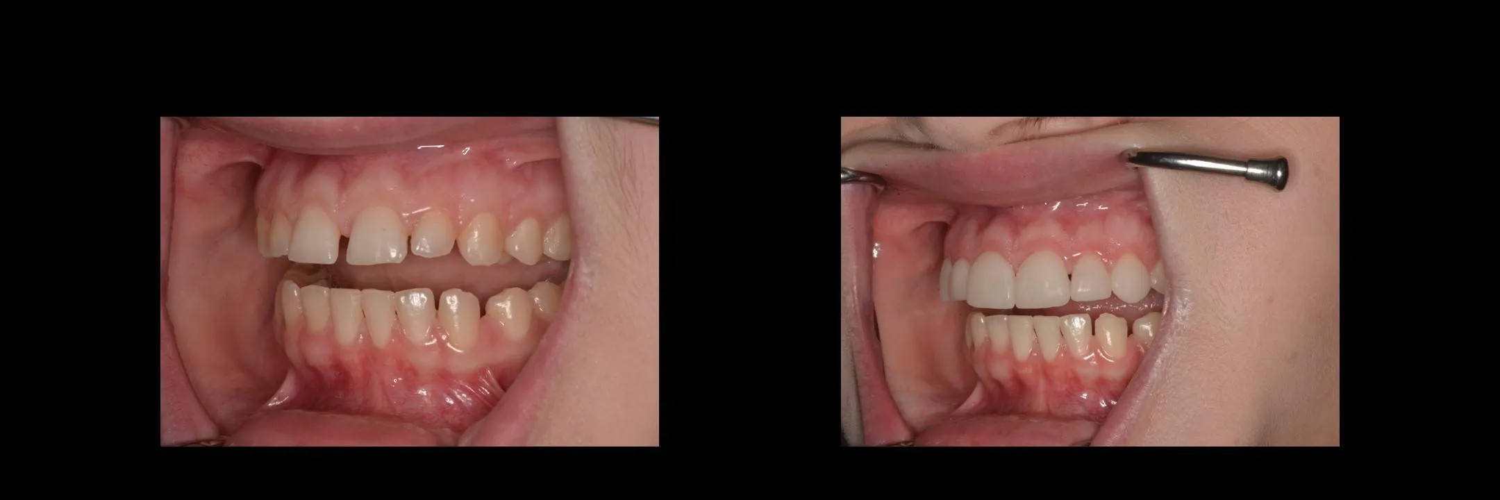 Before and After Minimally Prepared Veneers photo 11