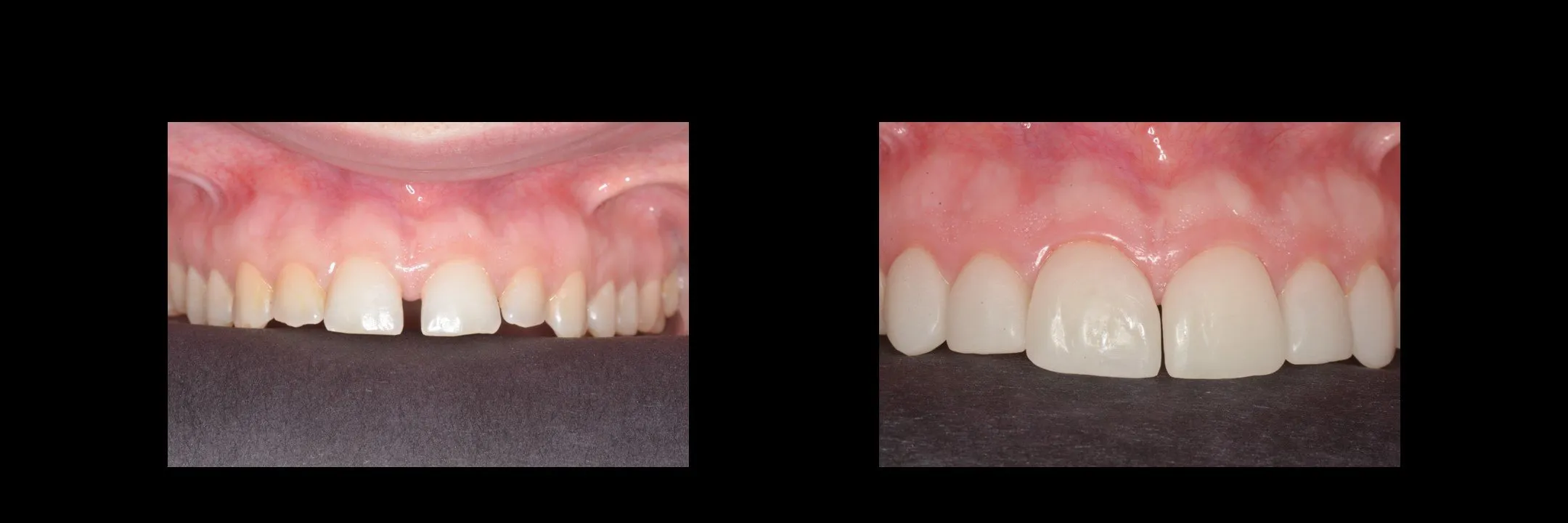 Before and After Minimally Prepared Veneers photo 12