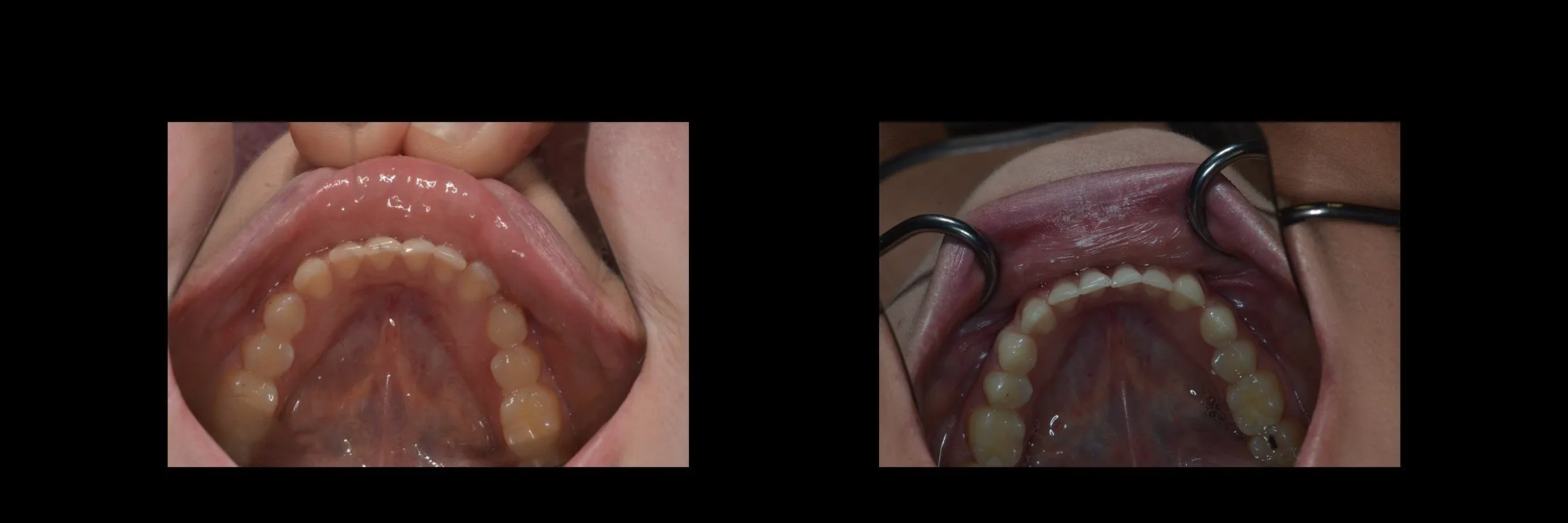 Before and After Minimally Prepared Veneers photo 14
