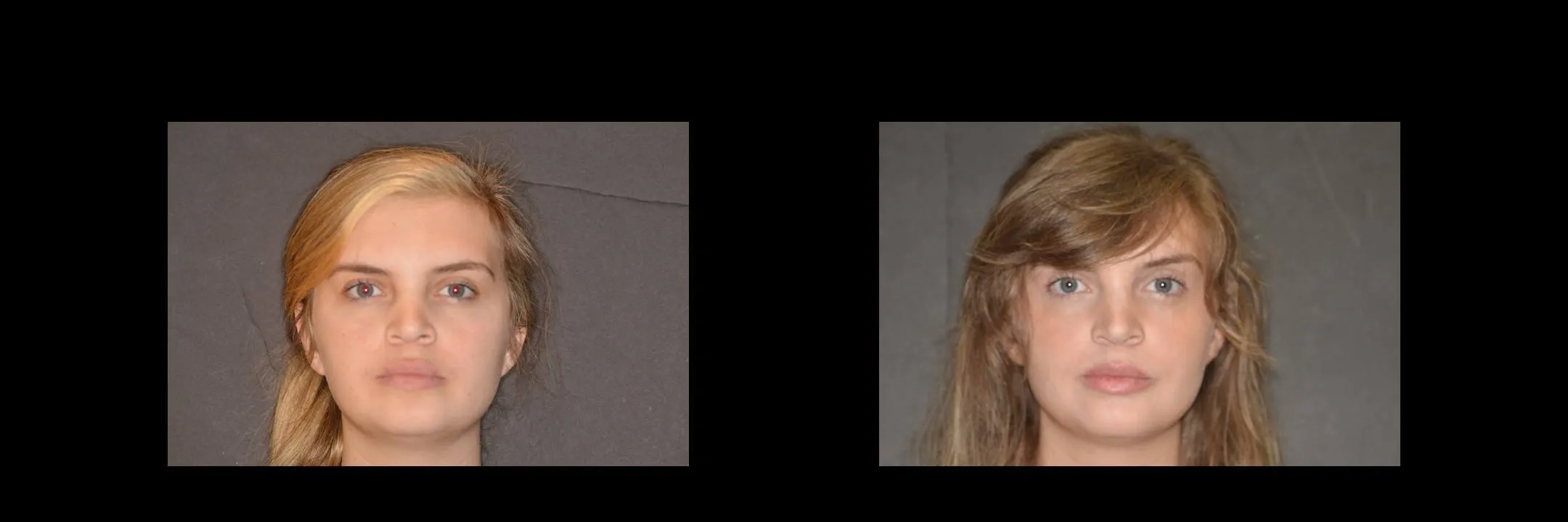 Before and After Minimally Prepared Veneers photo 15