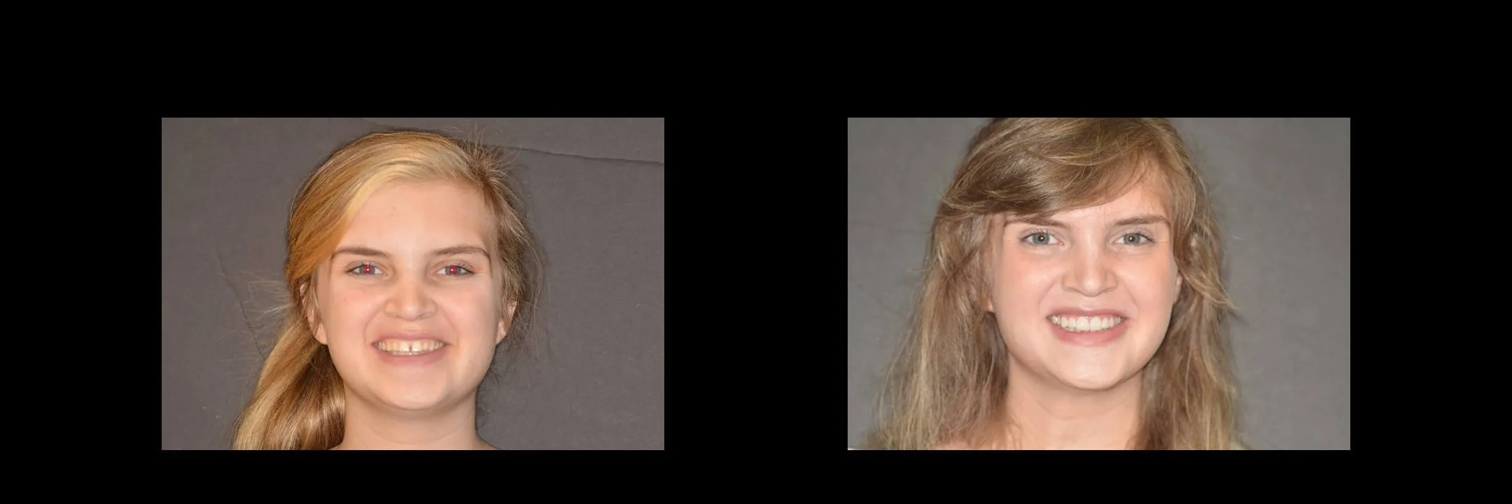 Before and After Minimally Prepared Veneers photo 16