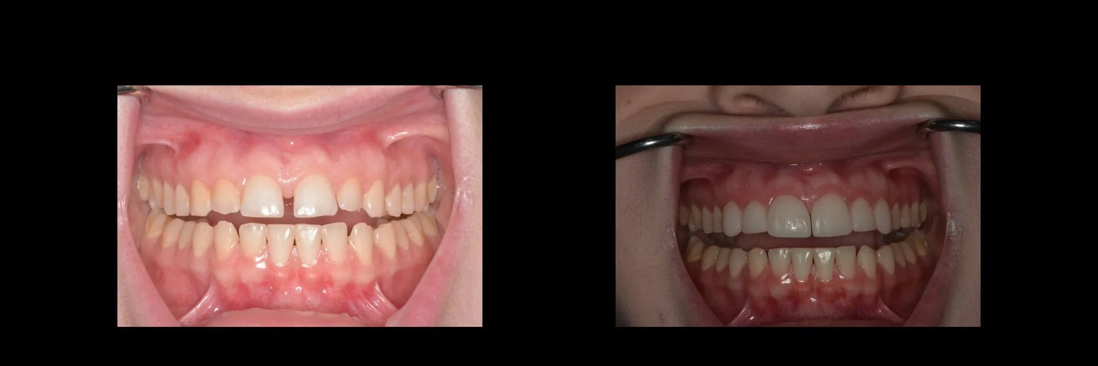 Before and After Minimally Prepared Veneers photo 9