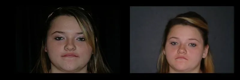 Before and After No Prepartion Veneers photo 13