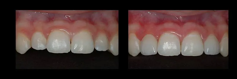 Before and After No Prepartion Veneers photo 8
