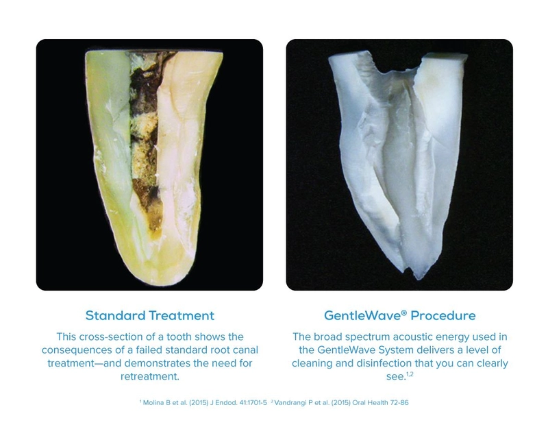 Comparison of an internal canal using standard vs gentlewave treatment