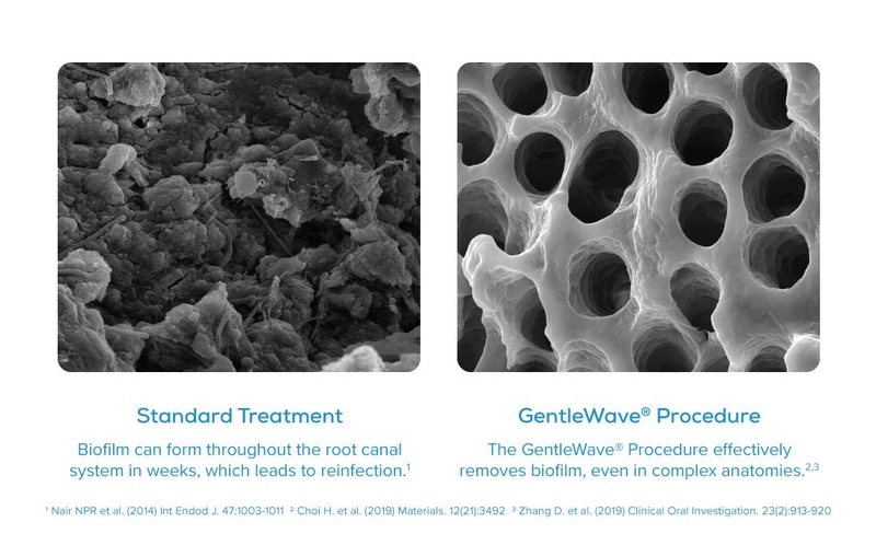 Standard treatment vs. GentleWave procedure